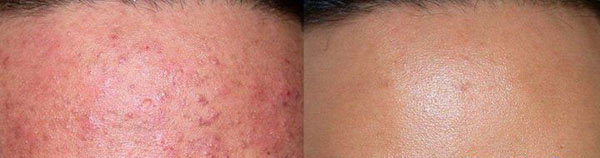 acne_head