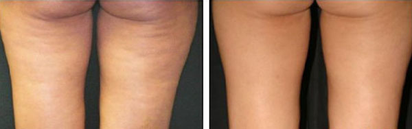 cellulite treatment