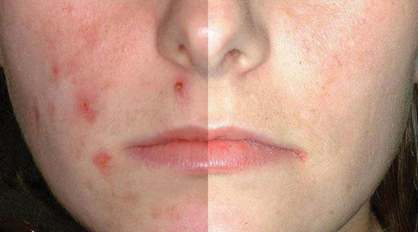 acne_face